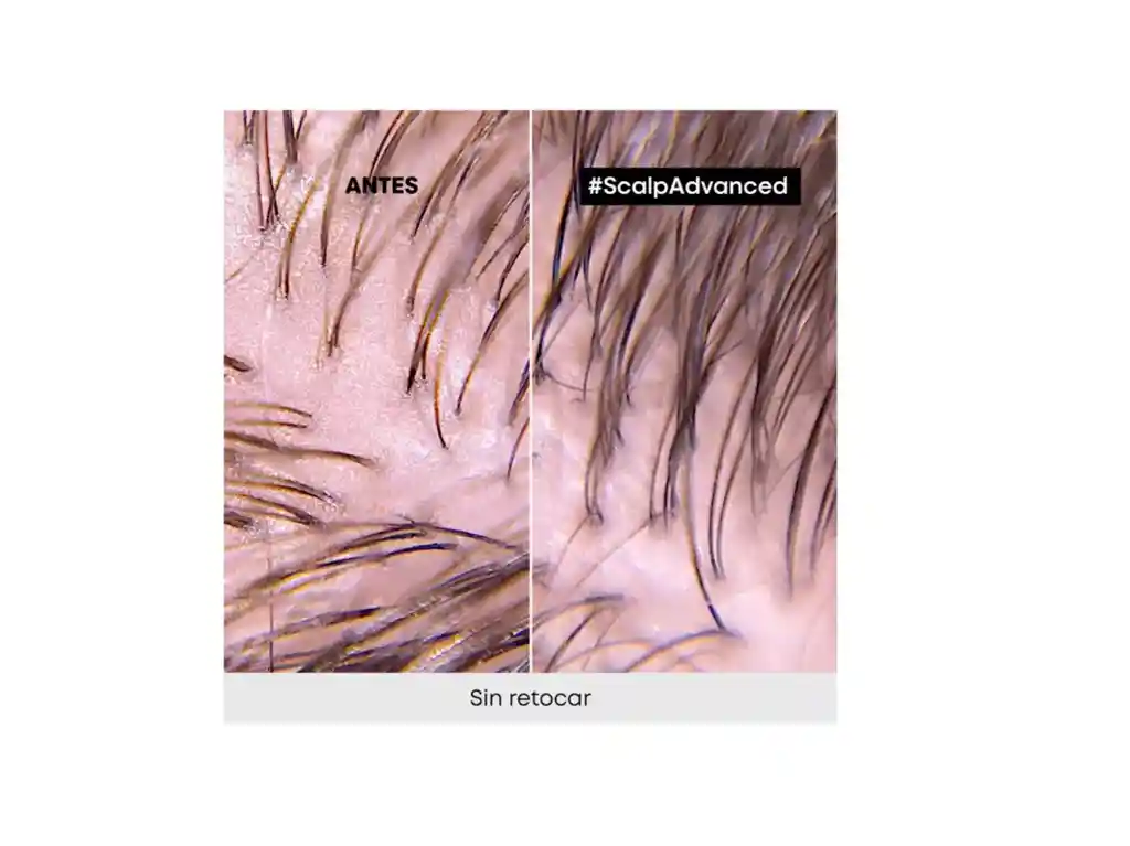 Shampoo Scalp Advanced Cabello Graso 300ml Loréal Pro